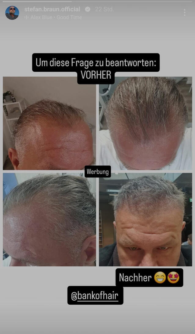 Stefan Braun Haartransplantation